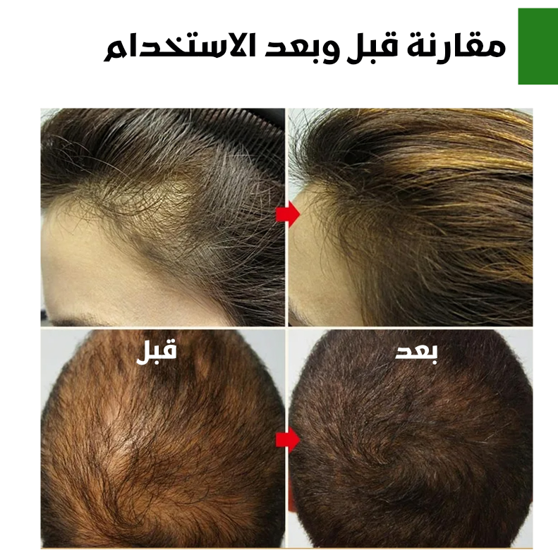 Rosemary Oil For Hair